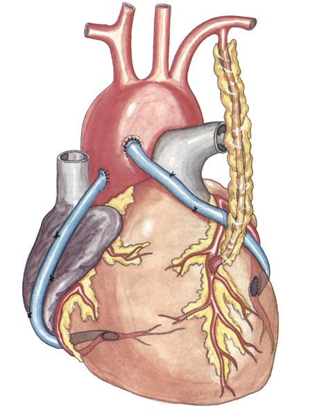 Kranskärlsoperation Kranskärlsoperation (bypassoperation) innebär att nya kranskärl kopplas på hjärtat så att blodet leds från stora kroppspulsådern direkt till kranskärlen utan att passera