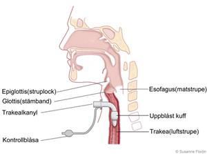 Okuffad/kuffad trakealkanyl För de flesta barn i behov av trakealkanyl, räcker det oftast med ett enkelt böjt litet rör att andas igenom, en okuffad trakealkanyl.
