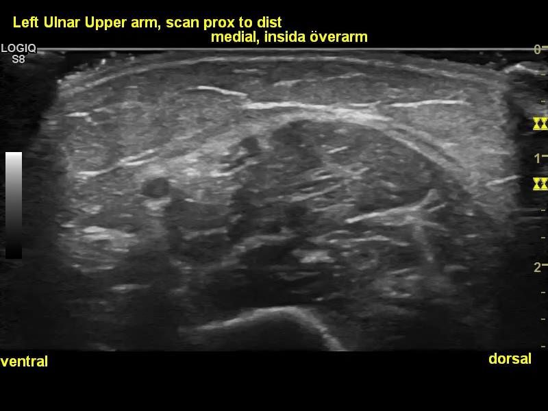 Exempel 1: sensorikstörningar arm, knöl i