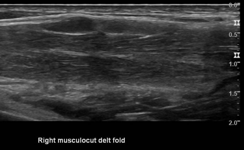 close to axilla, longitudinal view, constriction, nerve torsion Ultraljud, n musculocutaneous Påtagligt