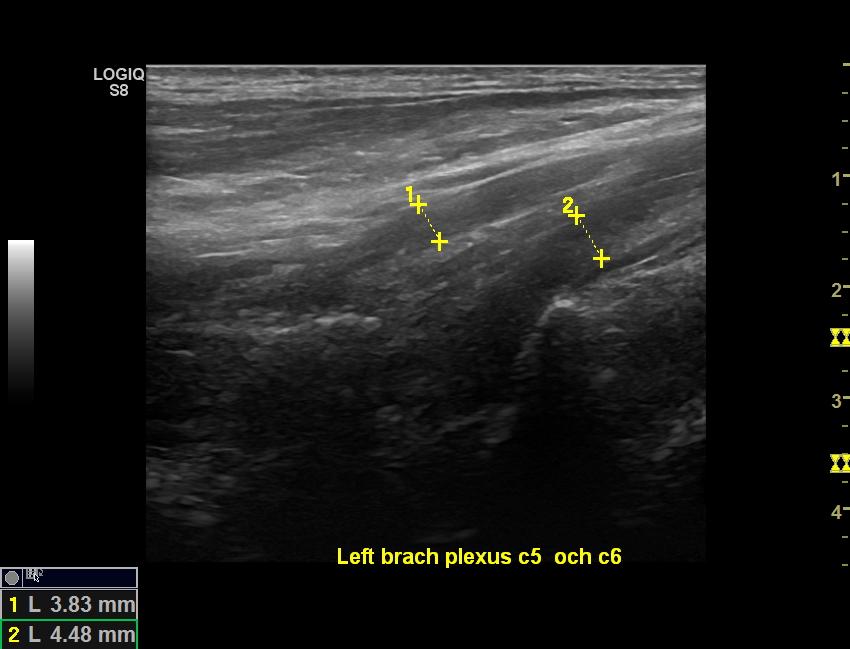 BUS, Bochum Ultrasound Score UPSS,