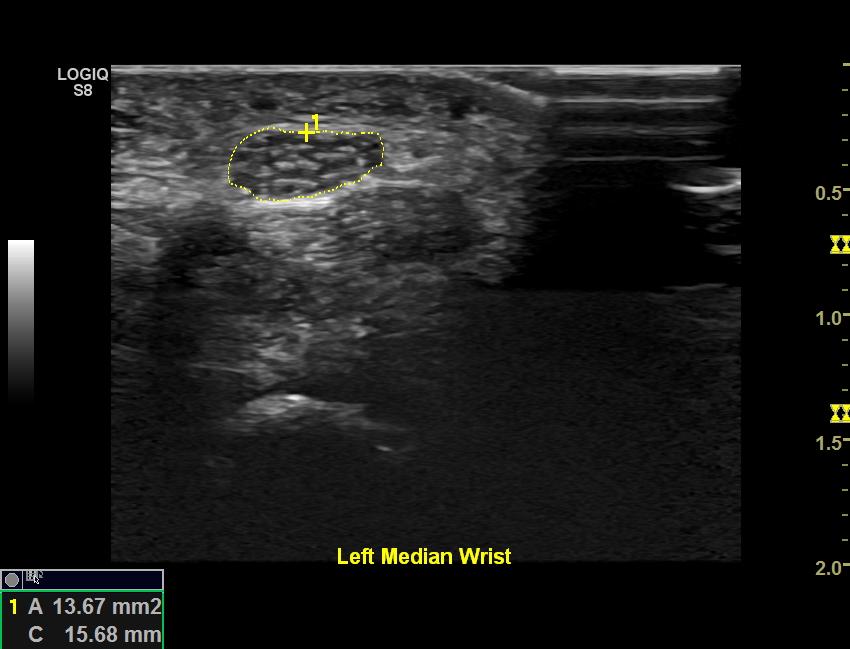 (Grimm 2015) Neuritis Ultrasound