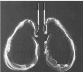 Fumo era um fator, e um fator importante, na produção do carcinoma do pulmão.