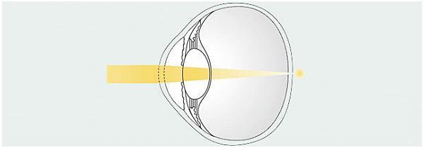 Ögat anses vara emmetropiskt när bilden av ett objekt vid oändlighet faller på näthinnan. (Rosenfield & Logan, 2009).