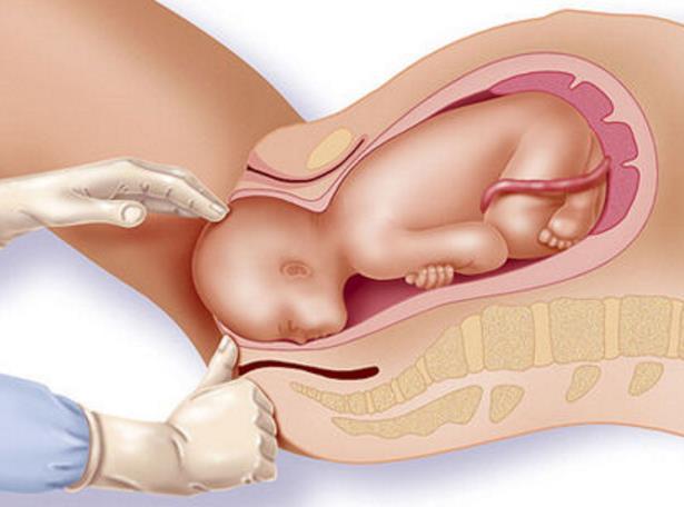 Förlossningssätt Vaginal förlossning förstahandsval Electivt sectio Obstetrisk indikation Perianal