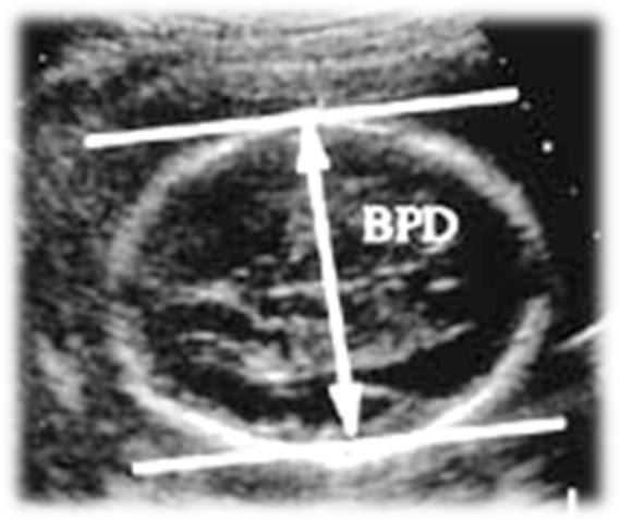 Symmetrisk bild Thalamus CSP Cavum septum