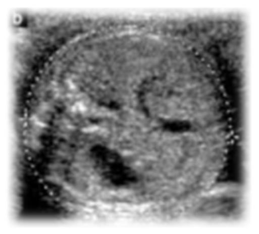 Medelvärde av abdominell diameter Symmetrisk bild Hela revben