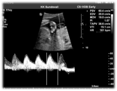 Pulsad doppler i A. Umbilicalis forts. Pulsatilitetsindex V 27 BFK 0 V 34 BFK 1 V 39 BFK 2 Precis som i fallet med a.