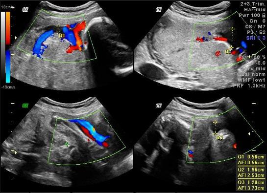 *Prognostic accuracy of cerebroplacental ratio and middle cerebral artery Doppler for adverse perinatal outcomes: a