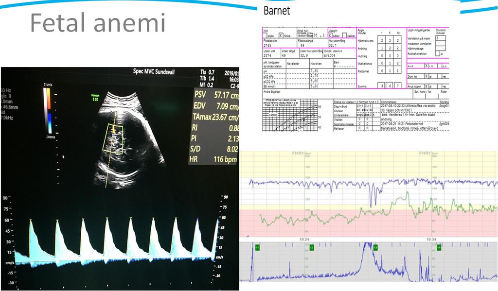 Fetal anemi Fetal anemi Akut hastig utveckling - FMH,