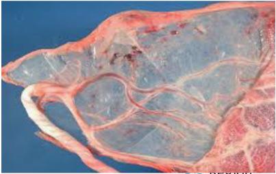 Placenta risk IUGR Single umbilical artery