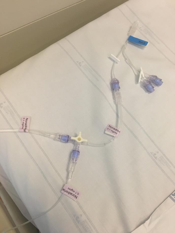 Koppla en 3-vägskran på svansen Säkerhetssprutan är kopplad till samma infusionsbana som Noradrenalininfusionen från
