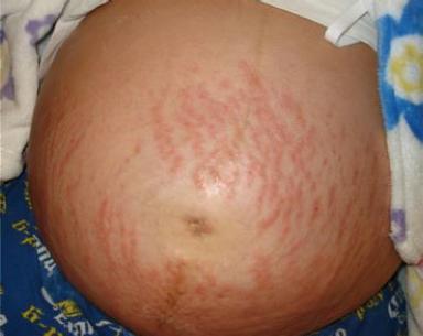 papules and plaques of