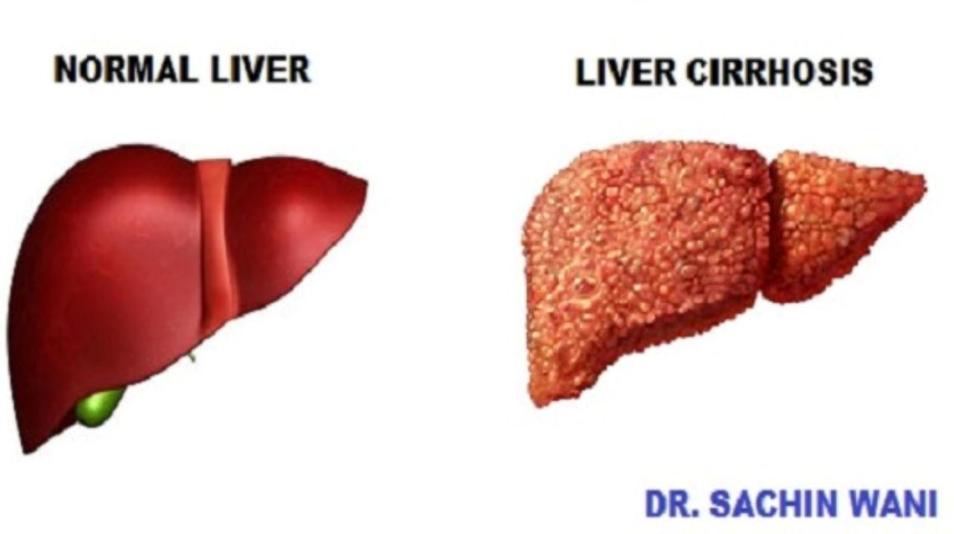 Levercirros- vad är det för något?