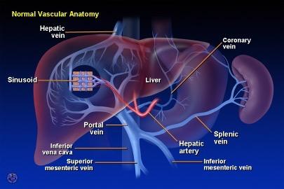 Varixblöding Ascites