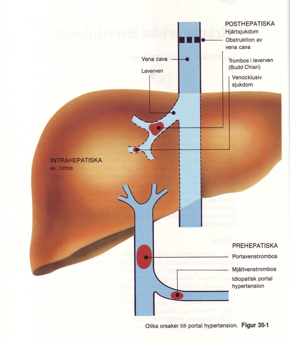 Cirkulatorisk leversjukdom Budd-Chiari (levervenstrombos) Portavenstrombos Take home message: