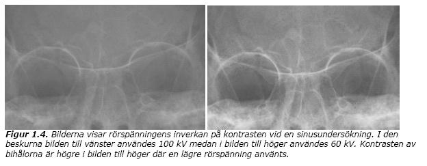 Kontrast för olika rörspänning 100 kv 60 kv Kontrastmedel Varför används kontrastmedel?