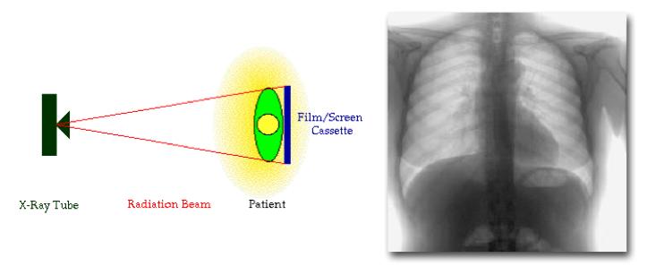 Röntgenbilden Bromsstrålning passerar den undersökta kroppsdelen Bilden byggs upp av primära och