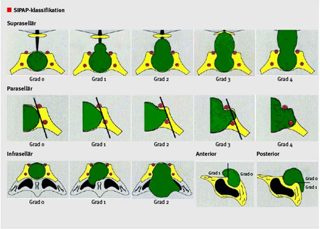 Bild 2. Referenser: 1. Edal AL, Skjödt K, Nepper-Rasmussen HJ. SIPAP--a new MR classification for pituitary adenomas. Suprasellar, infrasellar, parasellar, anterior and posterior. Acta Radiol.