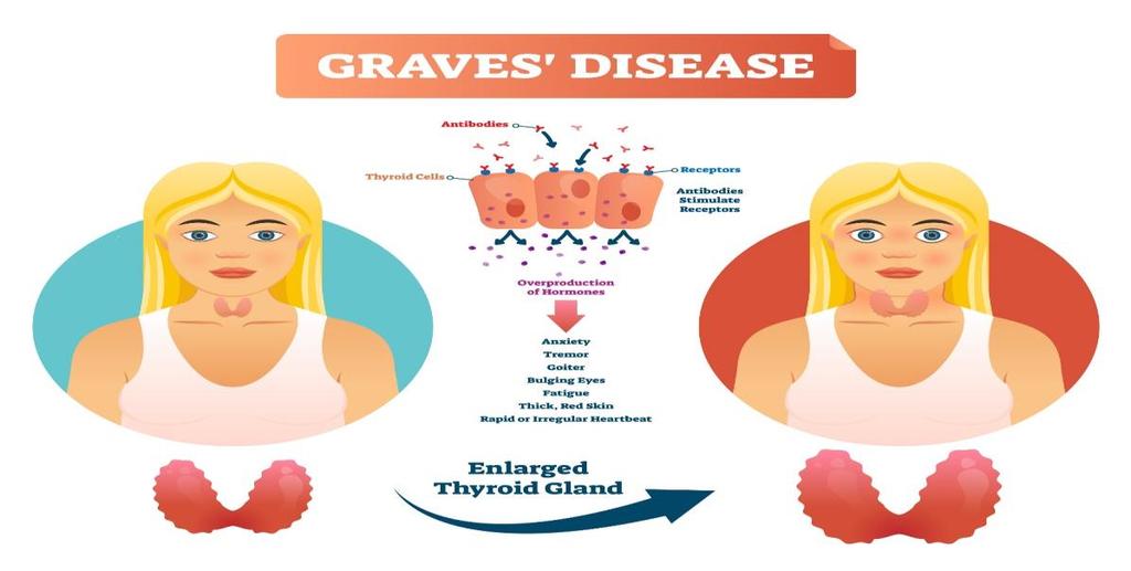 11.6. KIRURGISK BEHANDLING AV GRAVES SJUKDOM Vid Graves sjukdom blir sköldkörteln överaktiv och patienten drabbas av hjärtklappning, oro, ångest och ibland ögonbesvär.