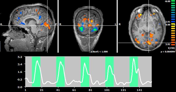 FMRI BILDER AV HJÄRNAKTIVITET MATTIAS