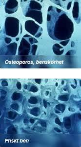 2020-02-03 39 Identifiering av risk för ohälsa Osteoporos Bedömning av trabekelmönster i