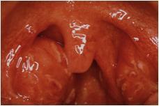 Akut faryngotonsillit-tonsillit=halsfluss Bakterier i 40-50% Virus i 30-40% grupp A streptokocker(gas)20-40% grupp G el C streptokocker 2-5% Okänt i