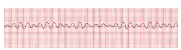 MEQ fråga 1 Nr Sida 4 av 4 En 66-årig man inkommer till akuten med ambulans en augustikväll 2011. Han berättar att han plötsligt insjuknat för 2 dagar sedan med hög feber och trötthet.