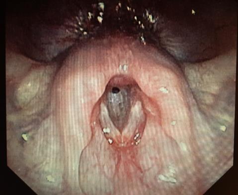 Subglottisk intubationscysta Subglottiska förändringar direkt under glottis kan oftast ses videoendoskopiskt, övriga ses först under narkos i spontanandning med 0 gradig optik kopplad till