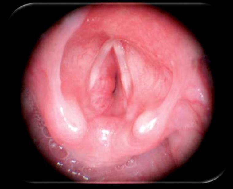 beroende på typ av stenos och samsjuklighet; endoskopisk resektion av subglottisk intubationscysta med kalla instrument, trakeoplastiker ex submucosal resektion av stenos med kalla instrument.