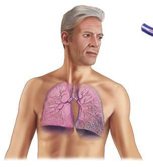 Kort om Vicore Vicore är ett särläkemedelsbolag med fokus på patienter med fibrotiska lungsjukdomar och relaterade indikationer.