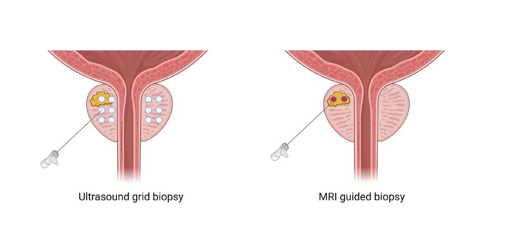 Figure 5. Schematic illustration of the ultrasound grid biopsy and MRI guided biopsy 1.2.2.3 Staging and grading e TNM staging system has been used to describe the tumor stage.