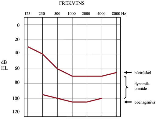 Onormal hörstyrketillväxt Även om en person med hörselnedsättning kan ha svårt att höra svaga talljud är det inte säkert att starka ljud upplevs dämpade i motsvarande grad.