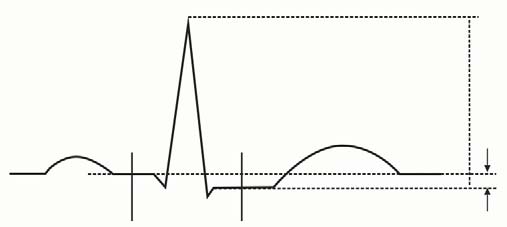 8.6.7 Skriva ut ST-segmentet Om du vill skriva ut det aktuella ST-segmentet och referenssegmentet väljer du [Skriv ut] i menyn [ST-analys]. 8.6.8 Ändra ST-larmgränserna De övre och nedre ST-larmgränserna kan ställas in individuellt för varje EKG-avledning.