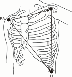 8.3.2 Välja AHA- eller IEC-avledningsplacering 1. Markera EKG-parameterfönstret eller kurvområdet så att menyn [EKG-inställning] öppnas. 2. Välj [Avl.uppsättn.