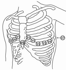 Bröstelektroden (V) kan placeras på någon av följande positioner: V1-placering: i det fjärde interkostalrummet vid den högra bröstbenskanten.