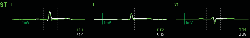 Det aktuella ST-segmentet visas i samma färg som EKG-kurvan, som vanligen är grön, ovanpå det sparade referenssegmentet, som har en annan färg.