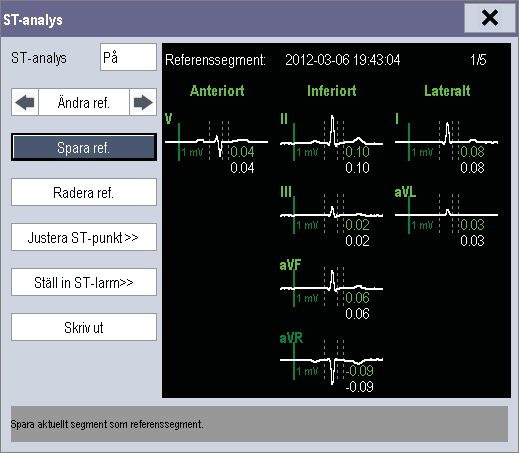 Markera ST-parameterfönstret eller ST-segmentområdet så att du kan öppna menyn [ST-analys]. 8.6.4 Spara aktuellt ST-segment som referens Välj [Spara ref.