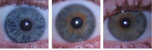 Figur 2. Typiska ögonfärger från blått till brunt. Melaninpigment bildas innuti melanosompartiklar i melanocyterna.