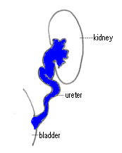 UVI < 3 års ålder samråd barnläkare Svårt få korrekta prov flera påsprov eller blåspunktat Risk njurskada