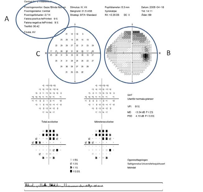 utskrifter som jämför utvecklingen av defekter över tid, t.ex. Glaucoma Progression Analysis (GPA) i Humphrey-perimetern, innehåller oftast inte tillräcklig information.