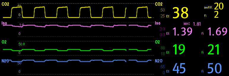 17.2 Förstå AG-bilden Gasmodulen kan skicka följande kurvor och mätvärden för alla anestesigaser som uppmätts, för visning på monitorns bildskärm: CO2-, O2-, N2O- och AA-kurvor awrr: