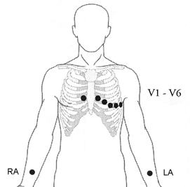 Elektrodplacering för 5-avlednings-EKG Nedan visas en elektrodkonfiguration när 5 avledningskablar används: RA-placering: omedelbart nedanför nyckelbenet, nära höger axel.