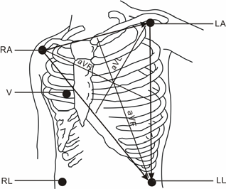 V4-placering: i det femte interkostalrummet vid den vänstra bröstbenskanten. V5-placering: på den vänstra främre axillarlinjen, horisontellt med V4-elektroden.