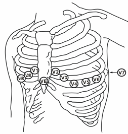VE-placering: över xifoidutskottet. V7-placering: på bakre bröstkorgen på den vänstra bakre axillarlinjen i det femte interkostalrummet.