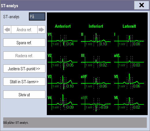 8.6.3 Tolka ST-bilden 8.6.3.1 ST-mätvärden Detta exempel visar ST-mätvärden med 5-avlednings-EKG. Monitorns skärm kan se något annorlunda ut än illustrationen. 8.6.3.2 ST-segment ST-segmentet visar ett QRS-komplexsegment för varje ST-avledning som mäts.