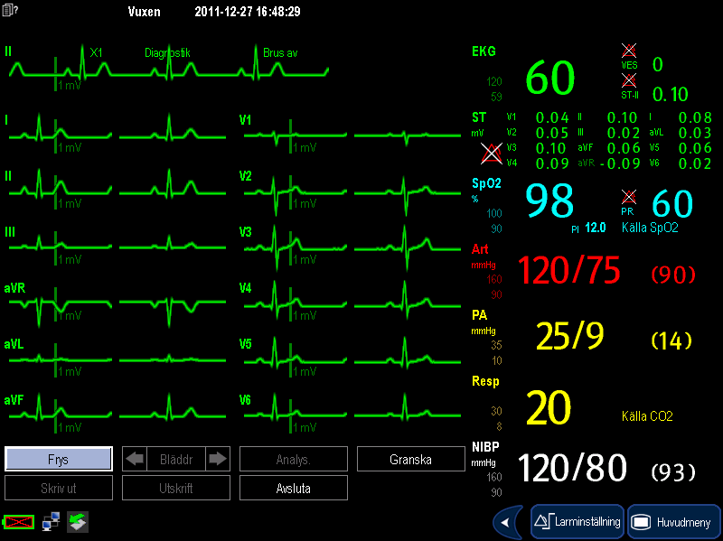 FÖRSIKTIGHET Var noga med att endast starta EKG-omlärning under perioder med normal rytm och när EKG-signalen är relativt brusfri.