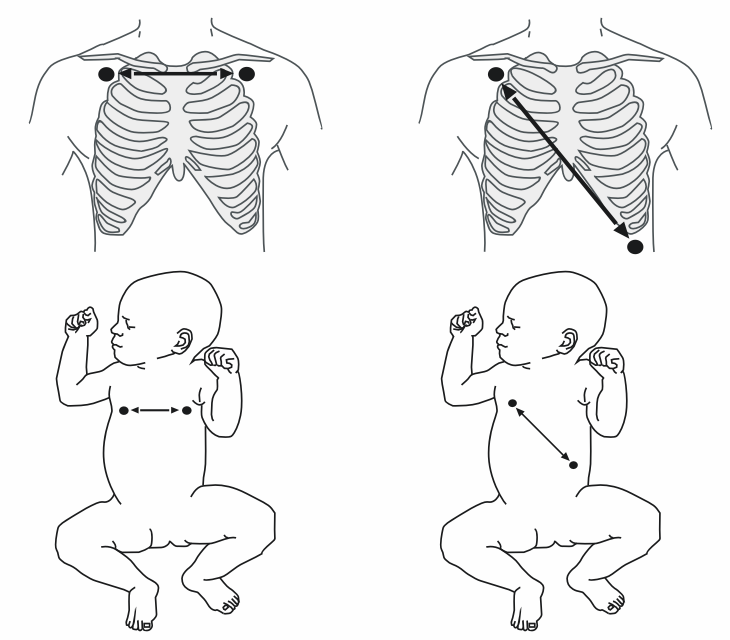 9.4 Placering av Resp-elektroder Eftersom huden är en dålig ledare av elektricitet är det nödvändigt att förbereda huden för att man ska få en bra respirationssignal.