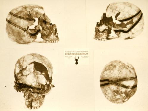Skelettet togs in i laboratoriemiljö för vidare undersökning och där kunde man konstatera att bandet hade gått i två slingor runt huvudet och att dessa två korslagts bak i nacken.