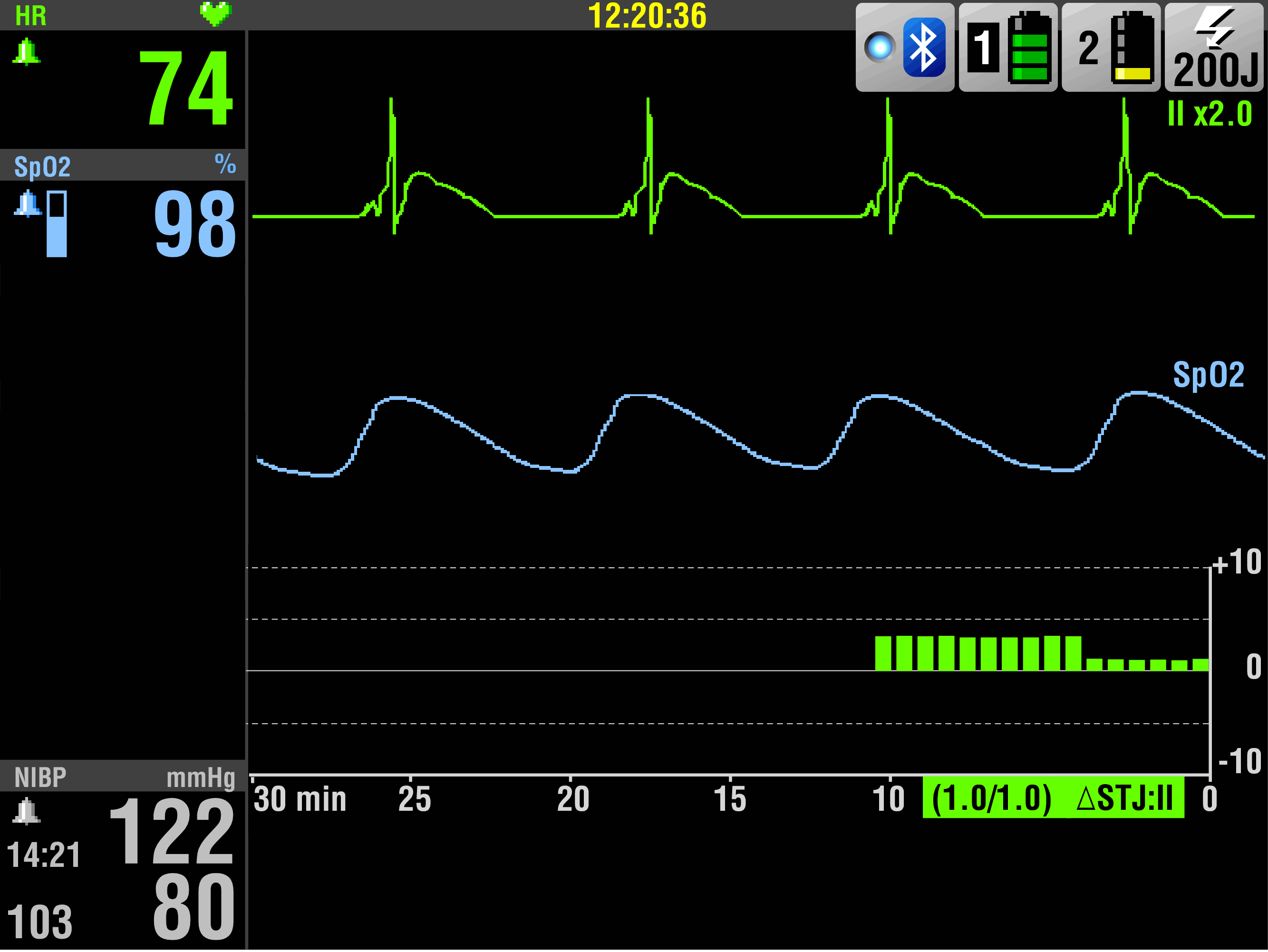 Ökning och sedan minskning i STJ Avledning Aktuell STJ Förändring i STJ Figur 4-18 ST-trendkurva Denna ST-trendkurva visar förändringarna i STJ från en patients första 12-avlednings-EKG över 10